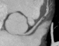 FINDING THE TRUE EDGE IN CTA by: John A. Rumberger, PhD, MD, FACC Your patient has chest pain. The Cardiac CT Angiography shows plaque in the LAD.
