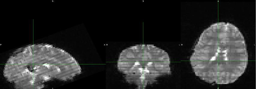 4.3 Realignment Figure 11. The axial view of a slice of a smri scans before and after the skull information was removed [3].