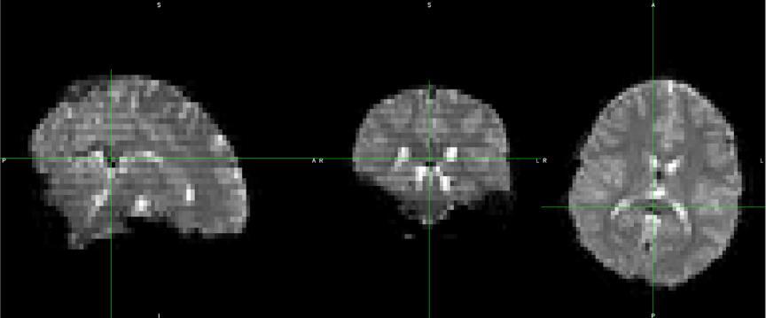 Figure 13. Slice of rsfmri data after motion correction. 4.4 Smoothing (Noise reduction) The spatial noise present in the rsfmri scans are generally Gaussian noise.
