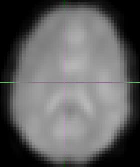 0 FWHM 4 FWHM 8 FWHM (a) (b) (c) Figure 14. The figure shows a slice of the smri scan with varying amount of smoothing applied to it. The figure (a) has no smoothing applied to it.