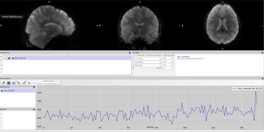 5.2 Time series As the rsfmri data contains multiple scans of the slices of the brain taken over time. The data collected is used to track any change in the neurological activity of a subject.