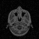 Original image Degraded image NLM(A) denoised image MSPCA denoised Figure 2. MRI image tested with the NLM(B)(Previous Method) = 27.3425, NLM(A)(Previous Method) =27.
