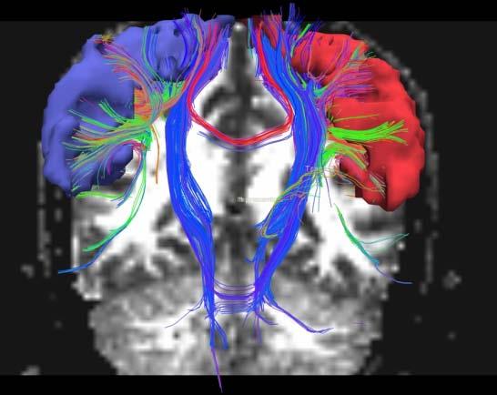 (a) (b) (c) (d) (a) deterministic tractography seeded in the