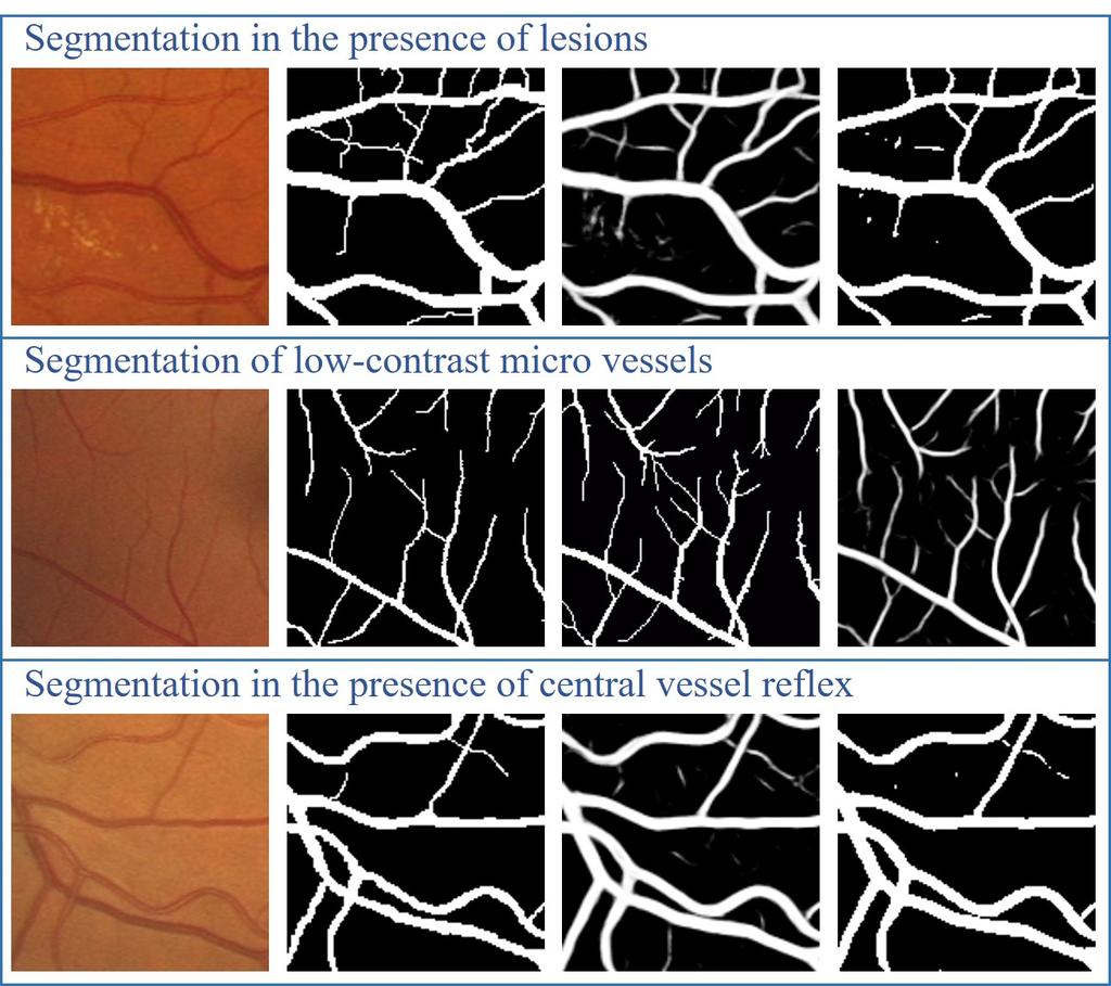 framework. 5) Performance on High-resolution Dataset: We evaluate the performance of the proposed joint-loss framework on the high-resolution fundus (HRF) image database. As shown in Fig.