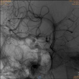 Cerebrovascular angiography