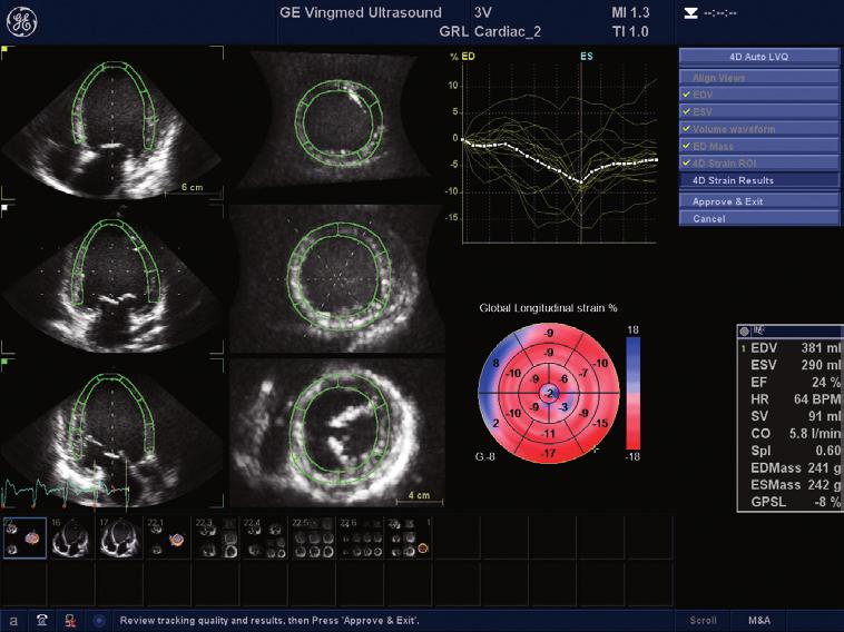 Extraordinary quantification Based on extensive feedback from clinicians just like you, TTE and TEE on the Vivid E9 are all about making imaging simple, intuitive, and quantifiable to help make your
