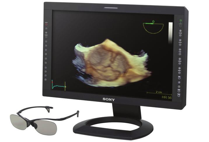 FlexiZoom provides a fast, efficient way to see a surgeon s view of the mitral valve to help increase flexibility and reduce keystrokes.