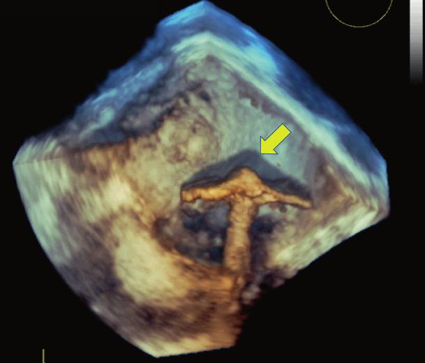 Image shown is a 4D TTE view of the mitral valve.