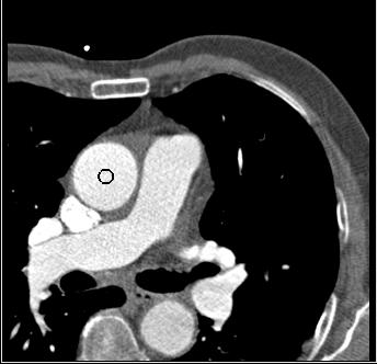 Fig. 2. In 97.0% of all cases, our presented algorithm automatically found a point within the ascending aorta (black circle).