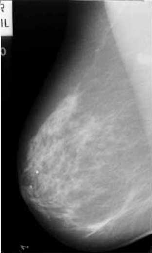 The use of breast tissue density features provide a good way of classifying mammographic images into BI-RADS risk assessment classes [1].