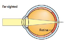 Analysis Analysis 4 continued } When the light focuses past the retina, the person will have blurry vision at close distances.