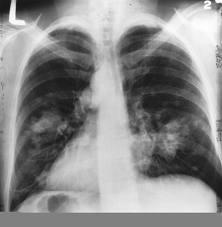 Example: Classifica>on Medical diagnosis: Based on the X- ray image, we would like determine whether the pa>ent has cancer or not.