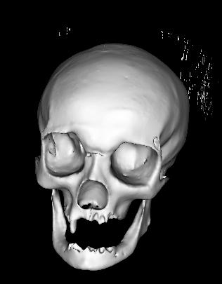 Once this has been done for several data sets, it is possible to derive statistical data about the depth and variance of soft-tissue at any chosen point on the skull model.