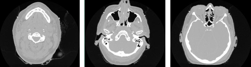 Figure 2: Slices from a CT data set of a head. phase of this project will be concerned with this alignment process.
