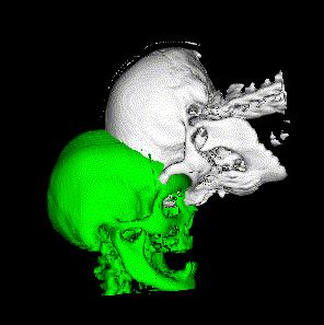 Figure 4: The green skull is the canonical model and the white skull is the subject. The left image shows the initial misalignment.