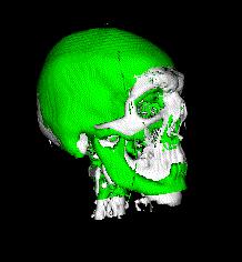 head scan resulting in an estimate of the model s face. This estimate will be reasonably accurate for areas with little soft-tissue variation such as around the eyes, the forehead and the cheekbones.