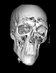 Figure 5: The left image shows a 3D polygonal mesh of a skull. The right is a 2.5D representation of the skull.