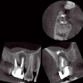 of the maxillary first and second molars.