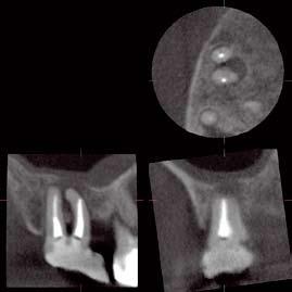 Lesion present on the mesio-buccal root of the maxillary right