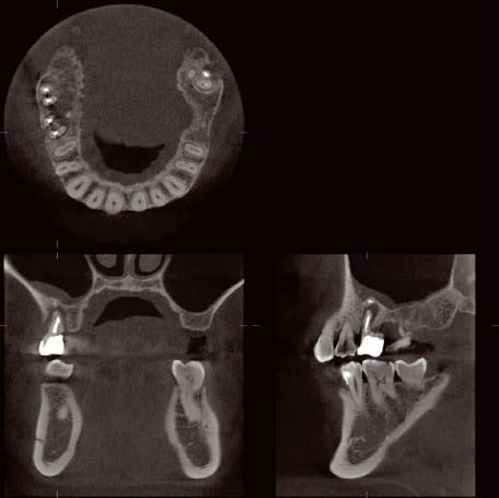 Clinical Cases 21 high quality 3D imaging allows for a comprehensive radiographic examination. The ø 80 mm x H 80 mm imaging area covers the entire mandibular, maxillary, and TMJ areas.