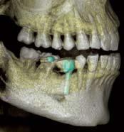 Implant Follow-up Follow up radiographic examination of an implant reveals a gross lesion apical