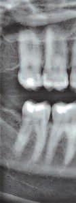 Apices and 3rd molars can also be captured, improving the diagnostic value of the