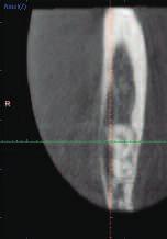 Axial (Z) Romexis Coronal (Y) Software Lesion in right mandible A