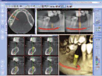 3D Implant Planning Module Sinus Study A cyst and inflammation