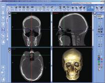 Romexis for accurate diagnosis Planmeca Romexis 3D Explorer, the 3D image acquisition