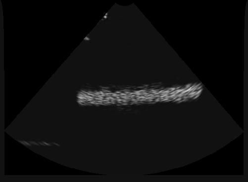 486 H. Zhong, T. Kanade, and D. Schwartzman O Fig. 1. Surface intersect with ultrasound image plane with finite thickness on the object surface should be a.