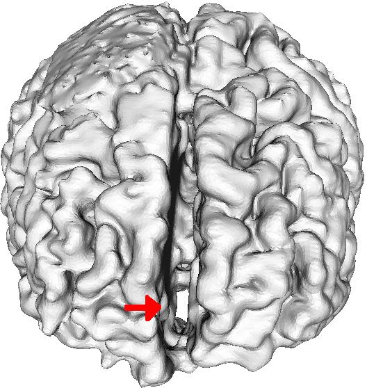Fig. 3. The algorithm repairs the erroneous handle between the two brain hemispheres, shown by the red arrow.