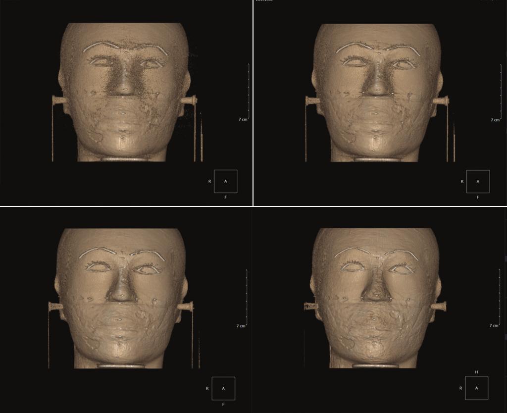 Linear accuracy of cone-beam computed tomography and a 3-dimensional facial scanning system: An anthropomorphic phantom study A B C D Fig. 5.