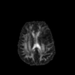 Automatic Segmentation of Brain Tumour