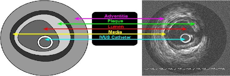 9 Figure 1.2: Explanation of vessel anatomy from the point of view of IVUS. this group in prior years. If the lumen and the catheter are clearly visible, no manual correction is required.