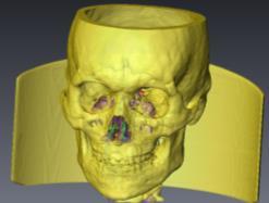 The 3D skull reconstruction results, as shown in Fig. 6(a), could be used to complete the skull 3D image reconstruction.