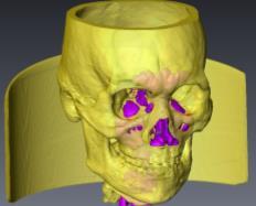 The 3D reconstructions of the nasopharynx, nasal cavity, and paranasal sinuses were shown in Figs. 6(b)-(d).