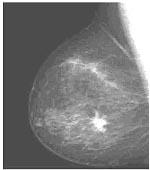 Fig. 3.3a: Oiginal digital mammogam Fig. 3.3b: Negative image Fig.