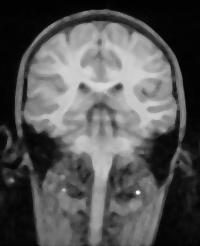 Fig. 3. Magnetic resonance image of human head (coronal section) Fig. 4.