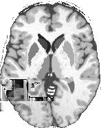 (a) (b) (c) (d) Fig. 4. Segmentation by LOCUS-TS on BrainWeb(a), 3D reconstruction(b), gradual improvement of putamen segmentation(c) and corresponding tissue segmentation(d). (a) (b) (c) (d) Fig. 5.