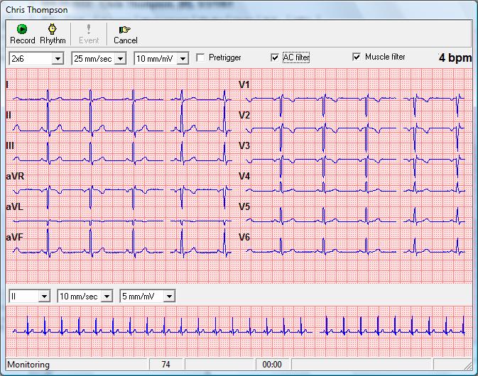 Resting ECG There were n issues identified with peratin f Resting ECG in the envirnment and tests cnducted.