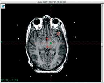 The patient s images can then be realigned with the AC-PC line so they are truly axial, coronal and sagittal, making them easier to reference with different brain atlases.