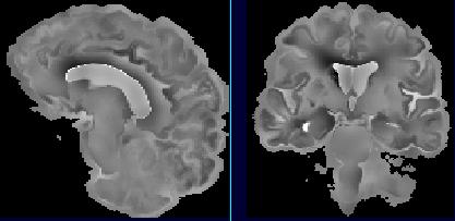 An Intensity Consistent Approach 499 Fig. 4. Enlarged orthogonal views through the Alzheimer s average atrophy rate map, illustrating the different contraction rates visible in the cortical gray matter layer.