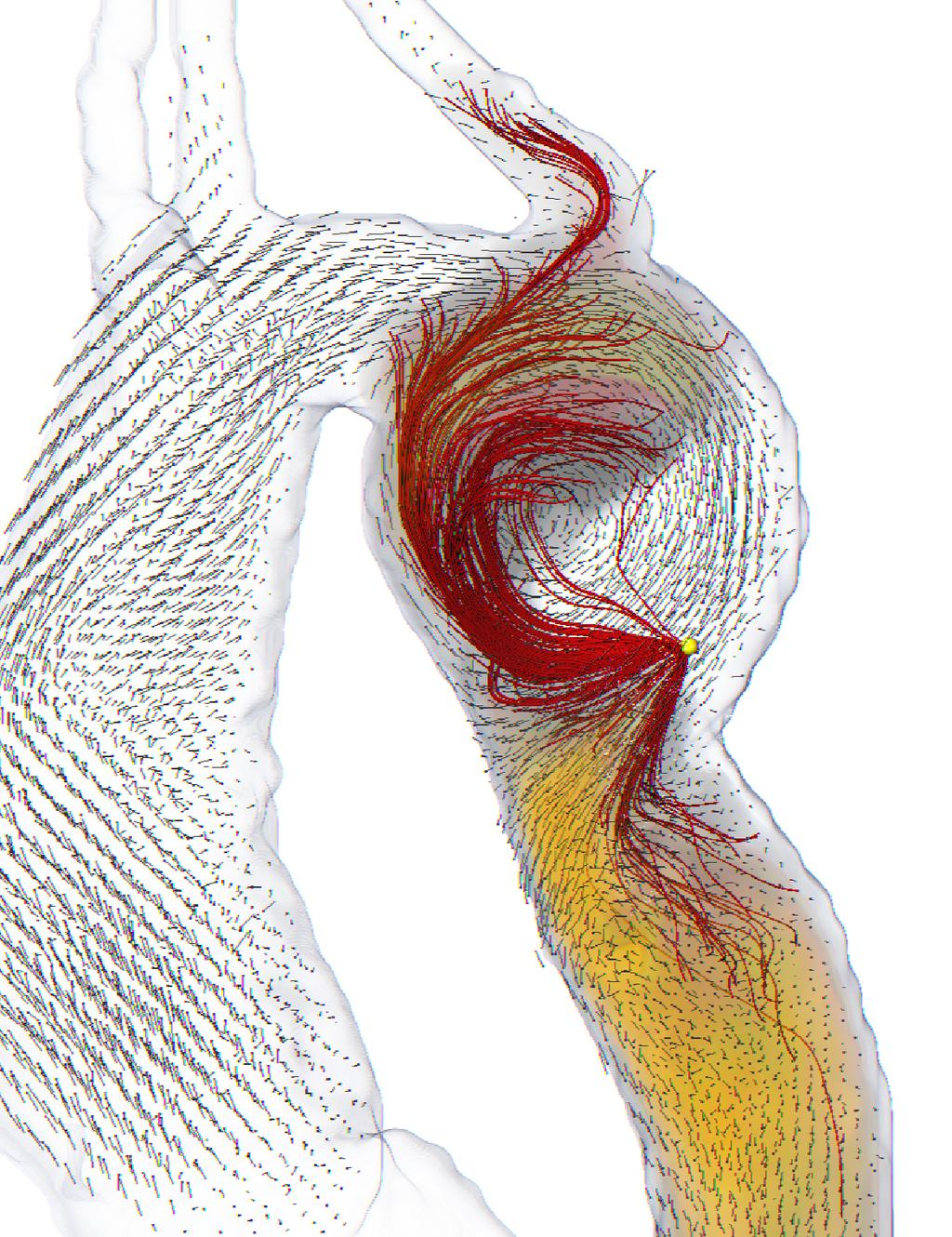 Blood Particle Trajectories in PC-MRI 293 Fig. 3. Results for a patient with an aortic aneurysm.