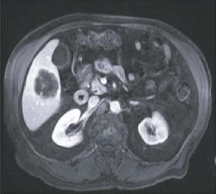 an affine registration between the CT #1 and the intra-op CT with the probes (#2).
