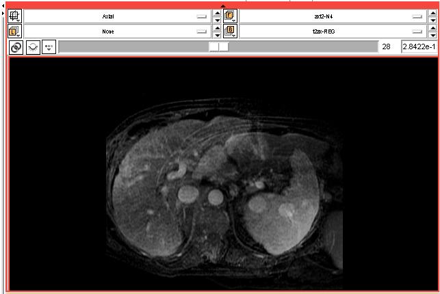 Step 4: MRI-CT Registration Result 1. Select t2ax-reg at Background layer and t2ax-n4 at Foreground layer. Switching between background and foreground you can now see the deformation applied. 2.