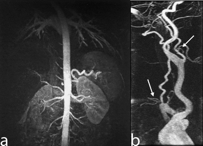 Applications These set of keyhole imaging sequences are specifically used for contrast enhanced angiography or dynamic susceptibility imaging, where a contrast bolus is injected and followed over