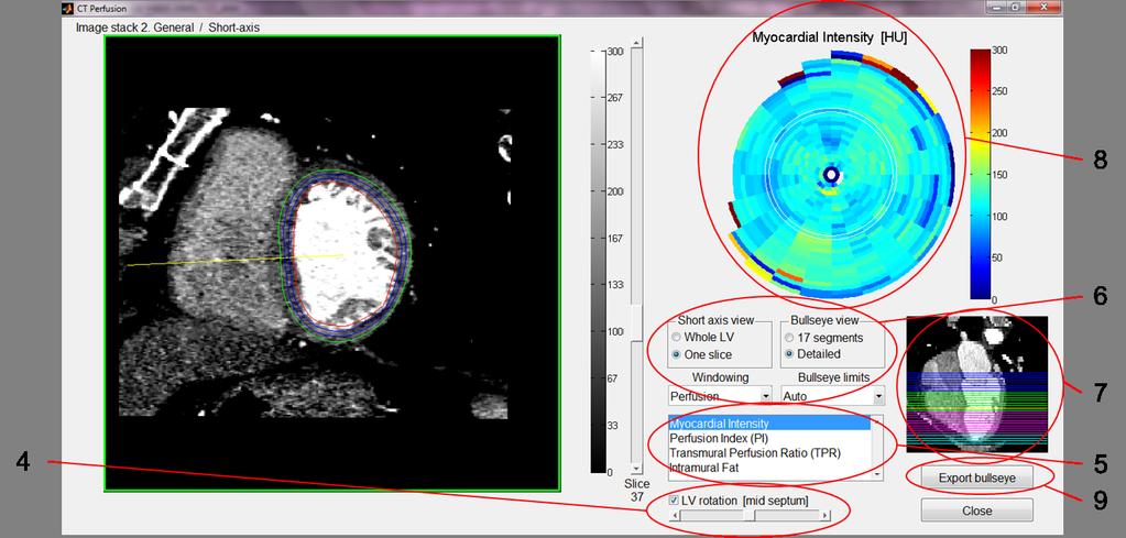 10 LV Perfusion analysis - Step by step 1. Start with manual or automated segmentation of the LV as described in Chapter 8. 2. Select the image stack to perform LV perfusion analysis of. 3.