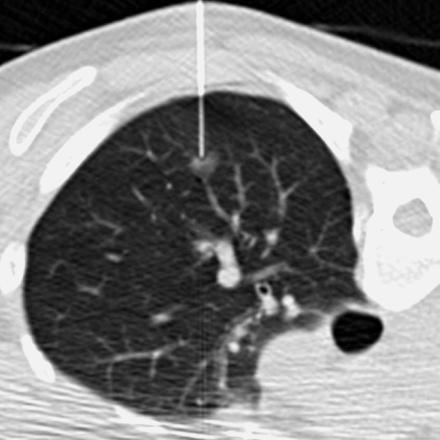 CT advanced applications 73 CT fluoroscopy the scanner provides pseudo-real time