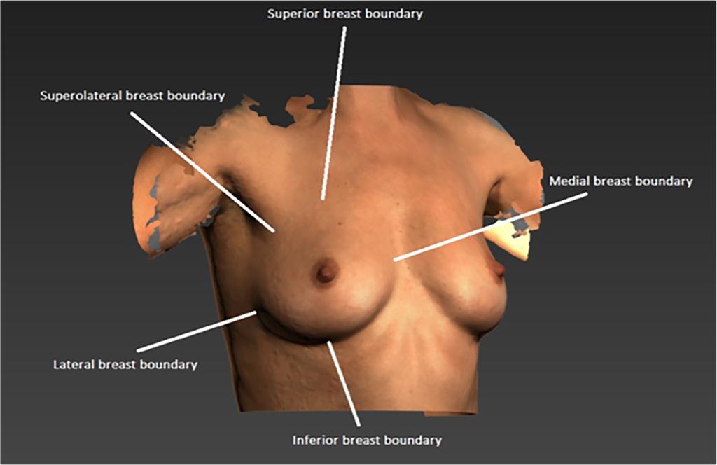 664 Eur J Plast Surg (2018) 41:663 670 Because breast boundaries determine the size and shape of the simulated chest wall, the selected breast boundaries significantly influence the calculated breast