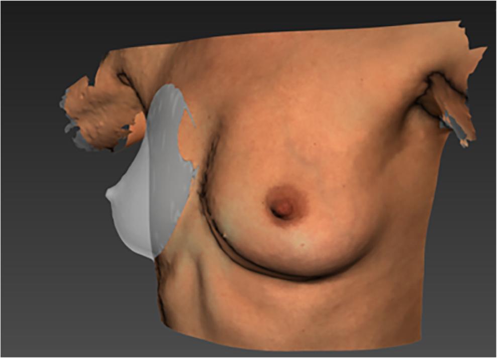 Eur J Plast Surg (2018) 41:663 670 665 Fig. 2 Example of a simulated chest wall behind the right breast. The breast was made transparent to make the simulated chest wall visible.